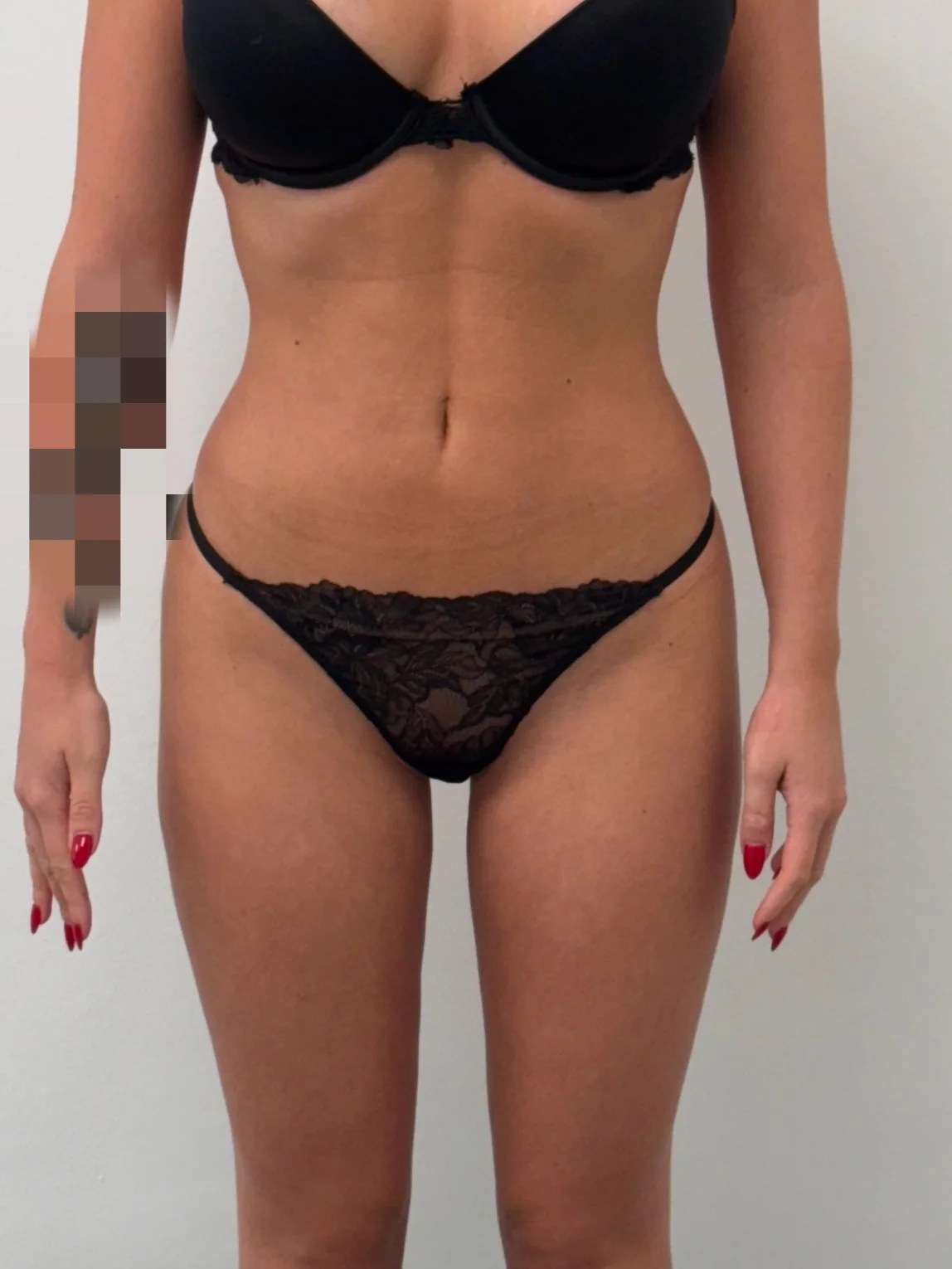 Behandlungsergebnis nach Wasserstrahl-Liposuktion an Bauch und Hüften bei einer Patientin mit ästhetischer Indikation, frontale Ansicht.