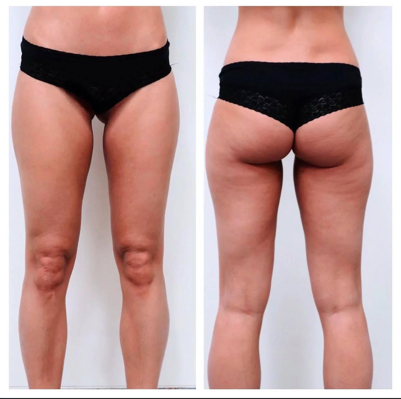 Behandlungsergebnis nach Wasserstrahl-Liposuktion an Oberschenkeln und Gesäß bei einer Patientin mit ästhetischer Indikation, frontale und dorsale Ansicht.
