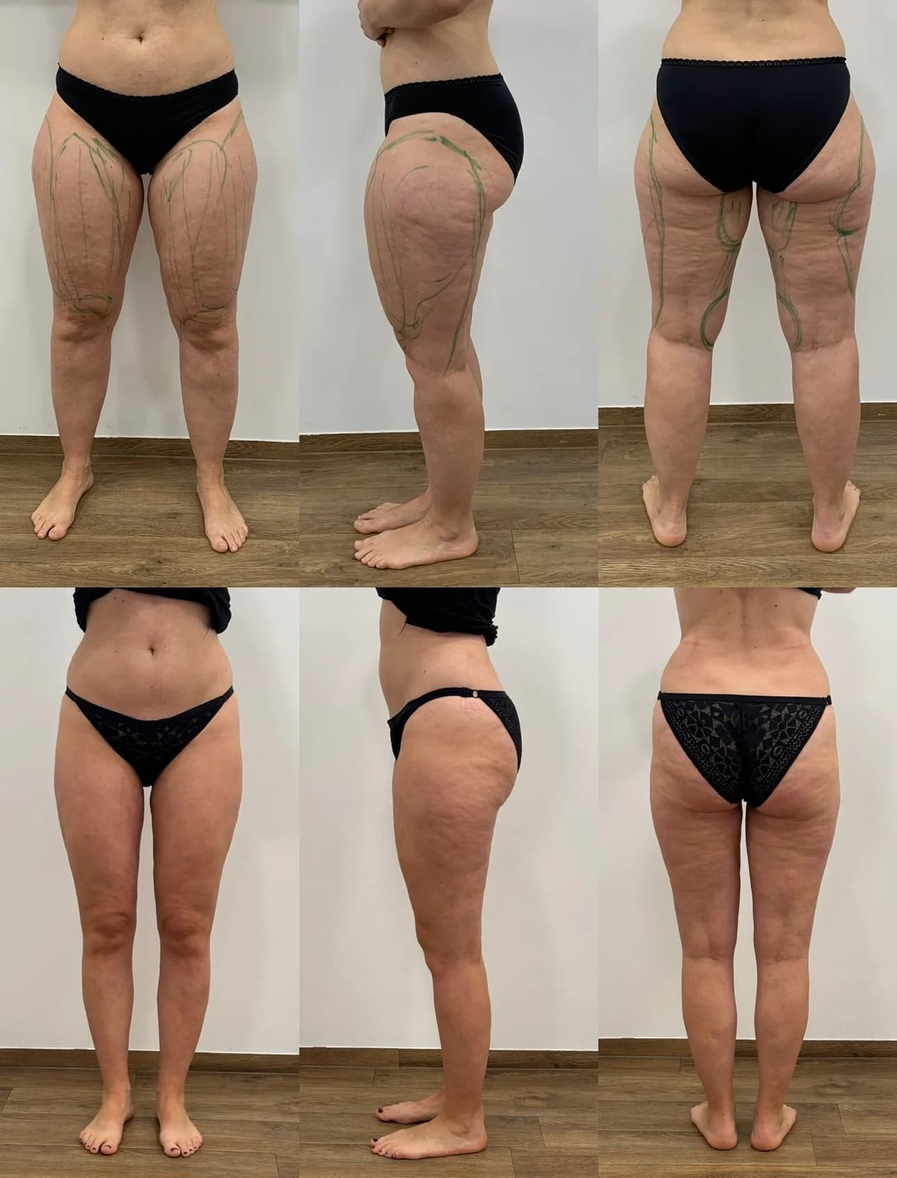Wasserstrahl-Liposuktion an Beinen und Hüften bei einer Patientin mit Lipödem Stadium II: Befund vor der Behandlung (oben, mit präoperativen Markierungen) und nach mehreren Behandlungsschritten (unten).